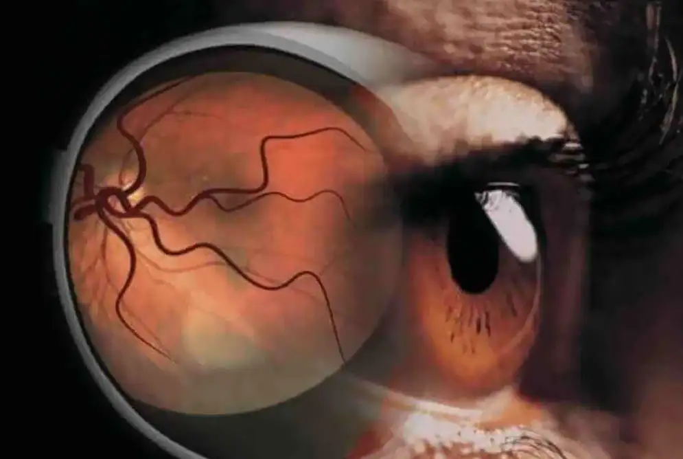 Some Interesting  Facts About Diabetic Retinopathy